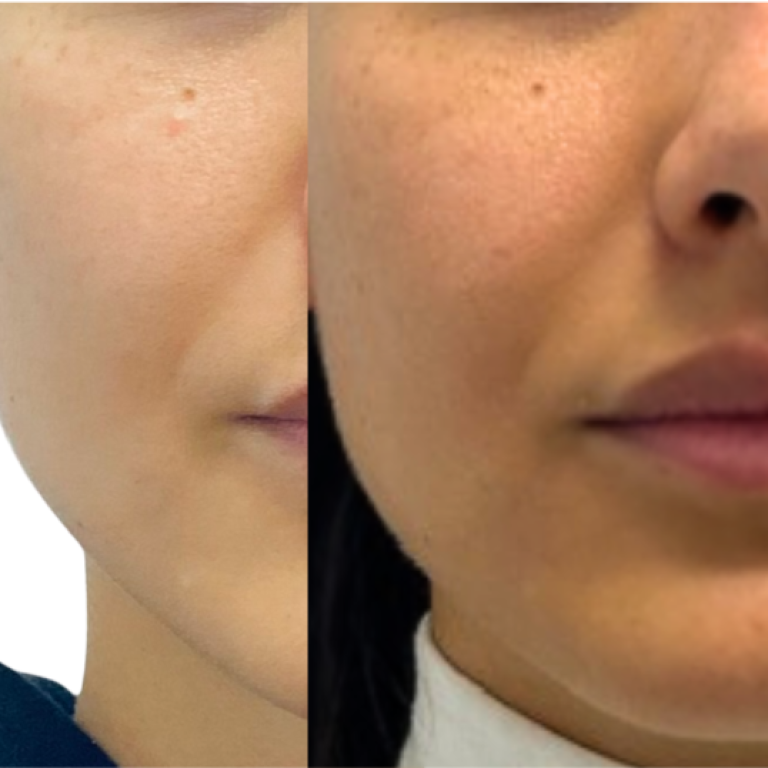 Jawline Definition Fotona Tightsculpting