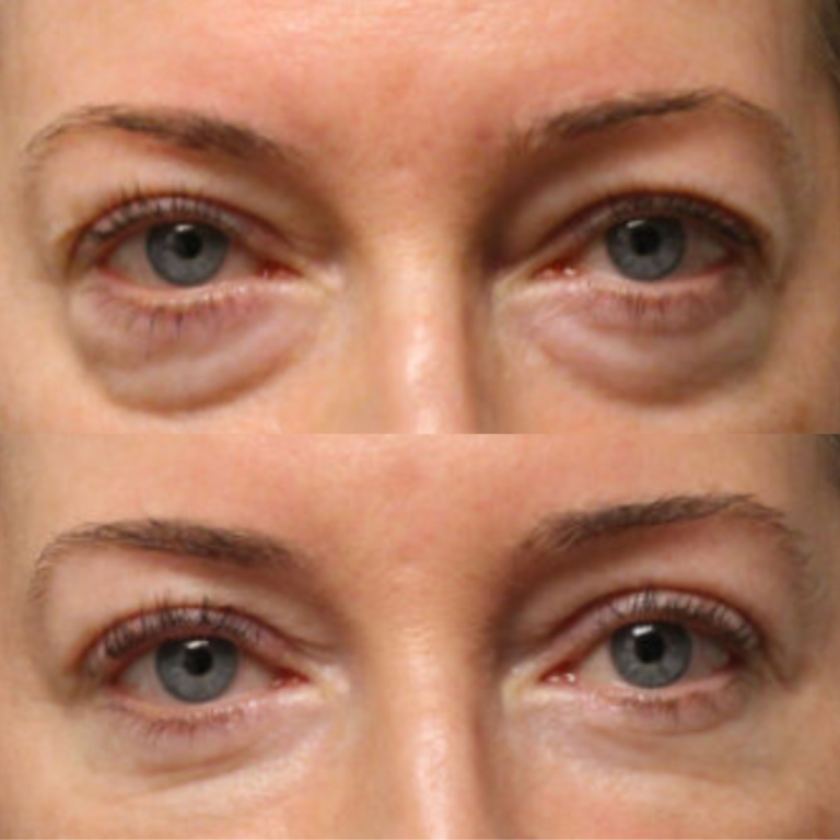 Eyes Laser Blepheroplasty