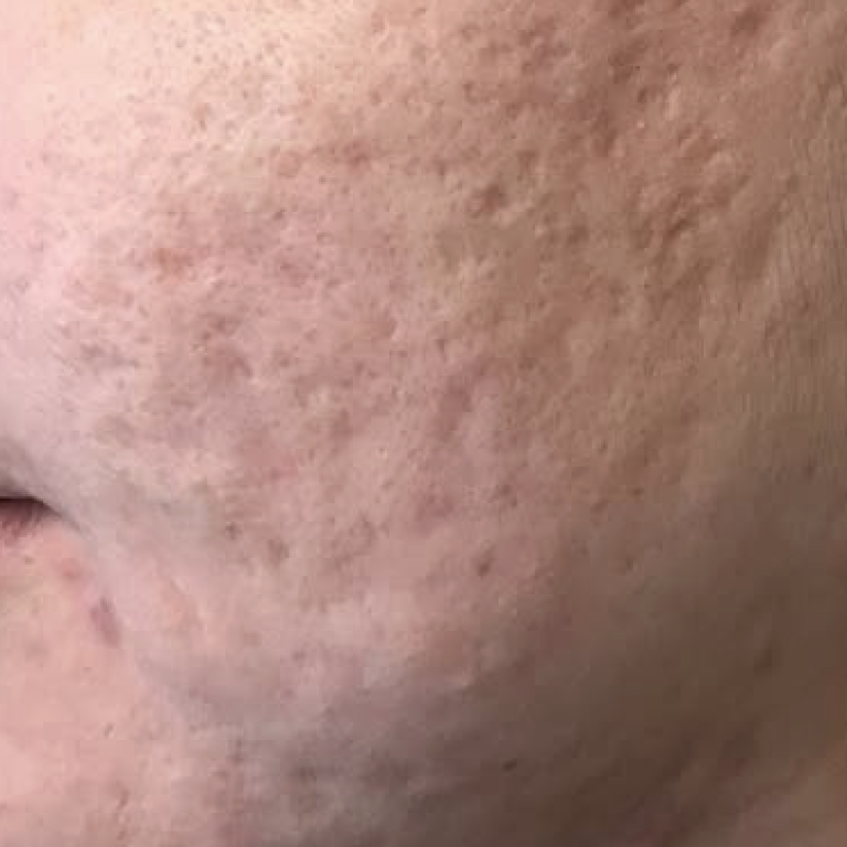 Acne scar before