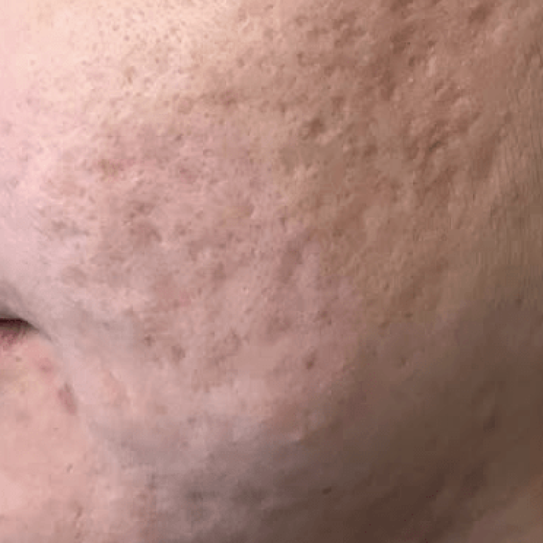 Acne scar before aesthetic medical spa treatment McLean VA En Santé Med