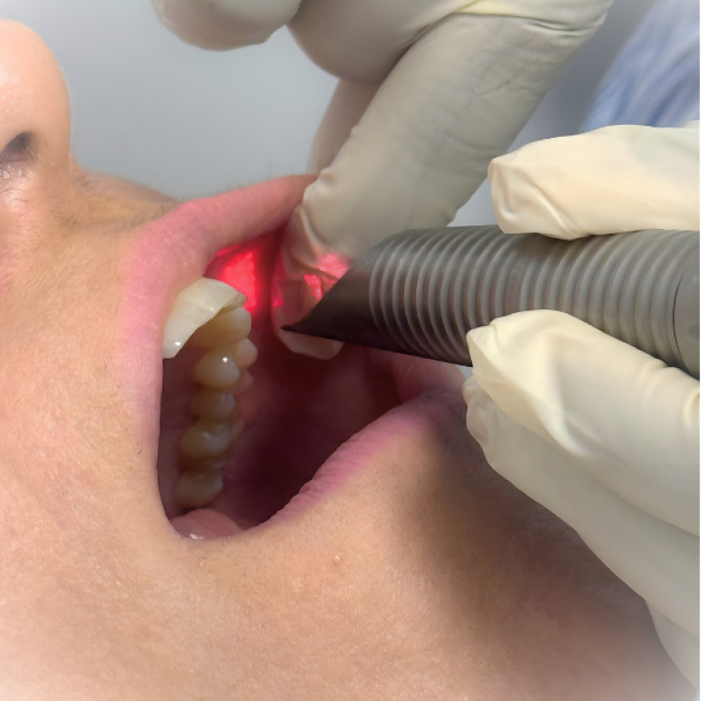 En Sante Med Endodermal Lifting