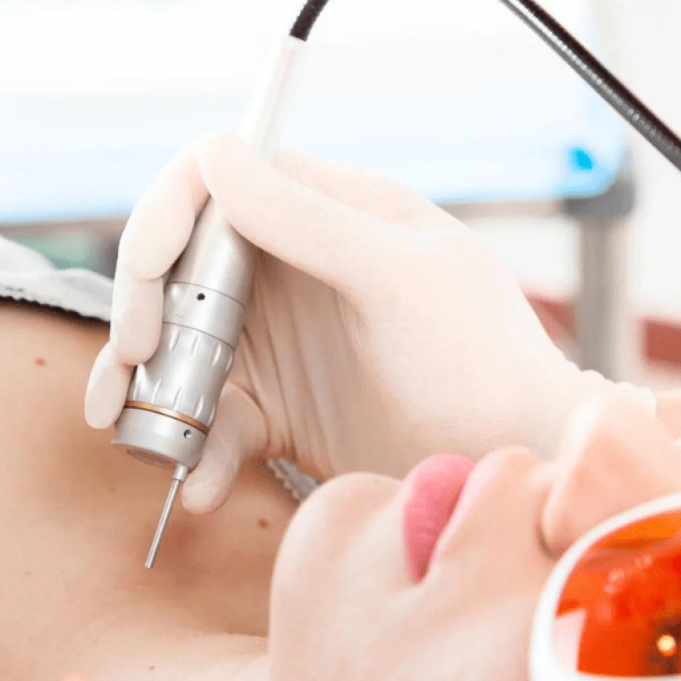 Fotona 4D Non Invasive laser facelift0 aesthetic medical spa treatment McLean VA En Santé Med