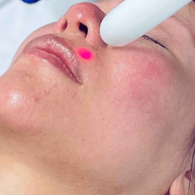 Fotona 4D laser face lift aesthetic medical spa treatment McLean VA En Santé Med