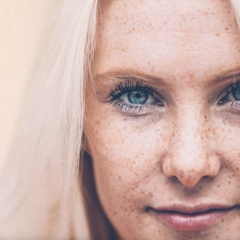 Fotona Laser After Care