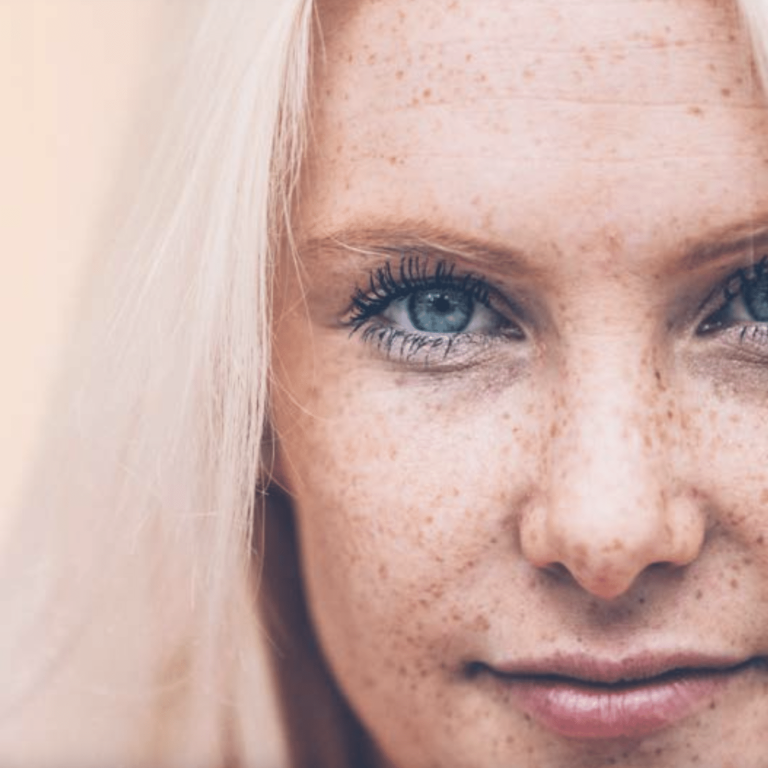 Fotona Fair Laday scaled aesthetic medical spa treatment McLean VA En Santé Med