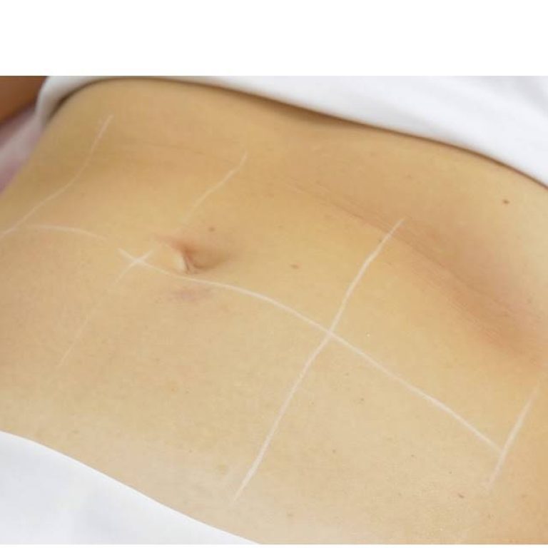 Fotona Tight Sculpting with Scanner e1750609243623 aesthetic medical spa treatment McLean VA En Santé Med