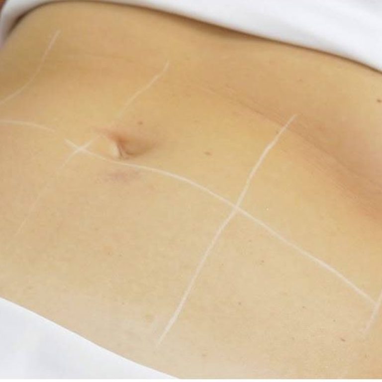 Fotona Tight Sculpting with Scanner e1767500429952 aesthetic medical spa treatment McLean VA En Santé Med