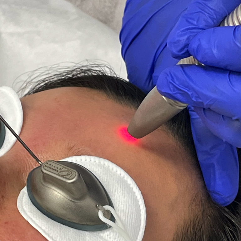 Laser Facial Fotona 4D Tysons Corner VA