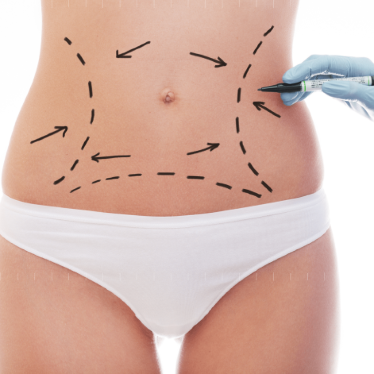 Laser Lipo