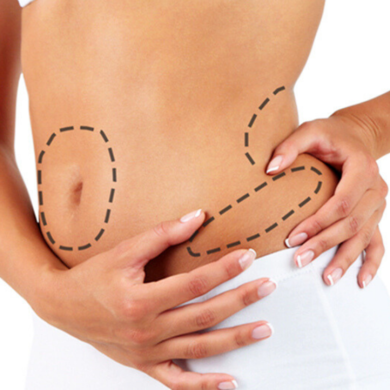 Stubborn Fat Treatment in Tysons VA