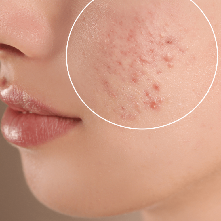 acne scars aesthetic medical spa treatment McLean VA En Santé Med
