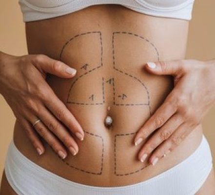 closeup womans belly with excess fat with marking her body liposuction plastic surgery scaled e1767657920726 aesthetic medical spa treatment McLean VA En Santé Med