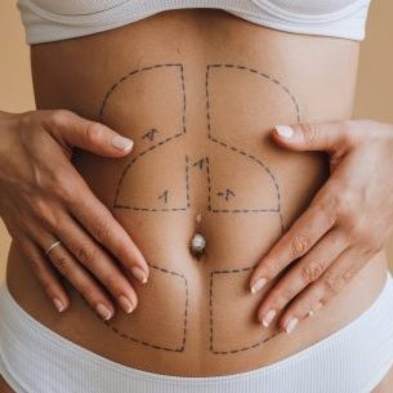 closeup womans belly with excess fat with marking her body liposuction plastic surgery scaled e1767657920726 aesthetic medical spa treatment McLean VA En Santé Med