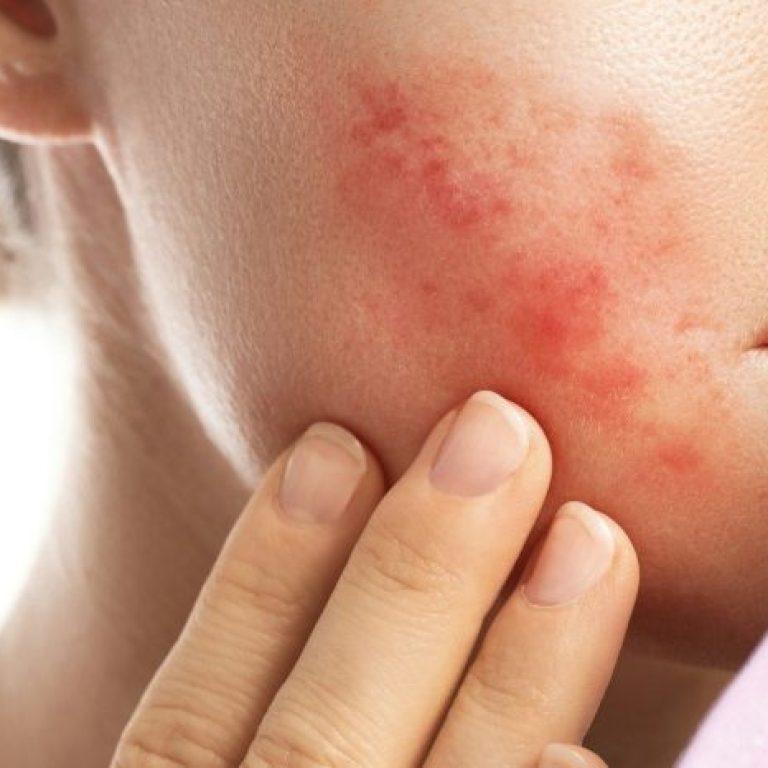 maskne acne breakouts from wearing a face mask 1 e1772863174251 aesthetic medical spa treatment McLean VA En Santé Med