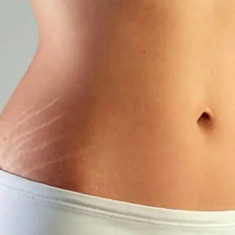 stretch-marks
