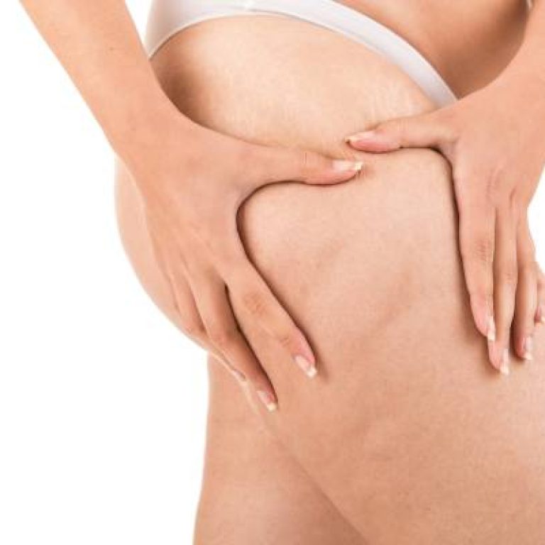 woman showing her cellulite e1735782526128 aesthetic medical spa treatment McLean VA En Santé Med